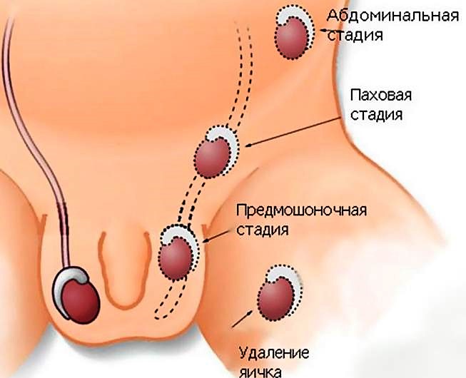 Лечение варикоцеле в клинике УРО-ПРО в Краснодаре